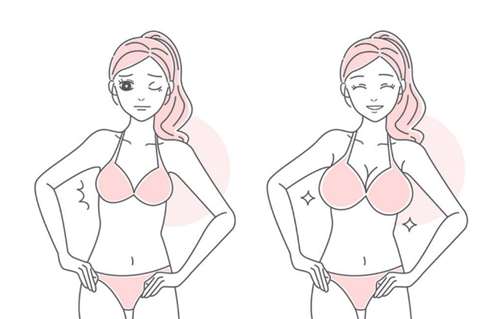 自体脂肪丰胸副作用全解析：感染、血肿、脂肪吸收等 6 类问题及预防要点