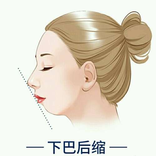 颊脂垫手术恢复指南：留院观察 1 天、1-2 周基础恢复期及饮食生活禁忌